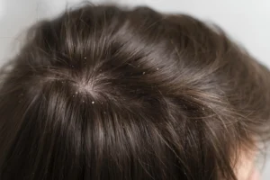 close-up-hair-with-dandruff